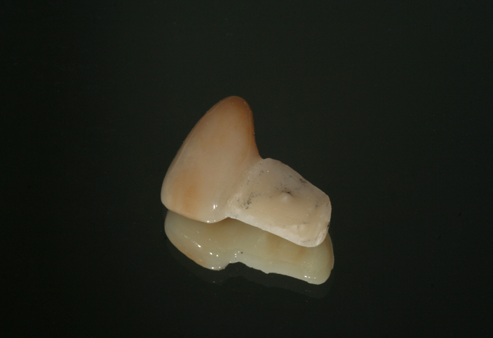 Πως γίνεται αντικατάσταση ελλειπόντων δοντιών με ελάχιστο ή καθόλου τρόχισμα;